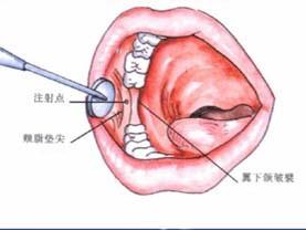 口腔医学353,章节练习,基础复习,口腔颌面外科学 口腔医学353,章节练习,基础复习,口腔颌面外科学