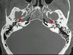 卫生招聘（耳鼻喉科汇总）,章节练习,基础复习,耳科学