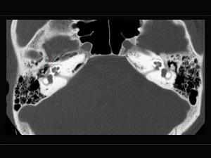卫生招聘（耳鼻喉科汇总）,章节练习,基础复习,耳科学