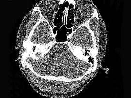 卫生招聘（耳鼻喉科汇总）,章节练习,基础复习,耳科学