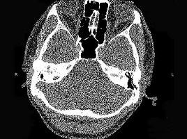 卫生招聘（耳鼻喉科汇总）,章节练习,基础复习,耳科学