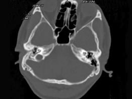 卫生招聘（耳鼻喉科汇总）,章节练习,基础复习,耳科学