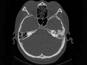 卫生招聘（耳鼻喉科汇总）,章节练习,基础复习,耳科学