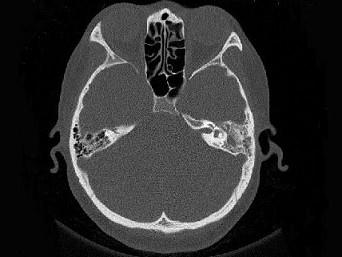 卫生招聘（耳鼻喉科汇总）,章节练习,基础复习,耳科学