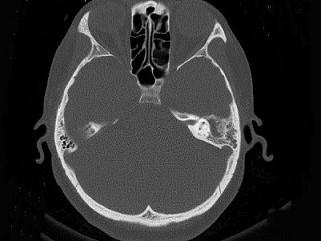 卫生招聘（耳鼻喉科汇总）,章节练习,基础复习,耳科学
