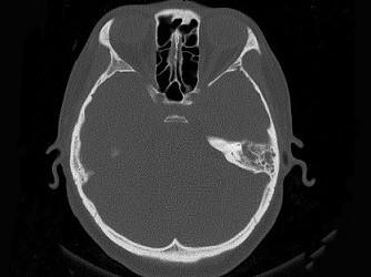 卫生招聘（耳鼻喉科汇总）,章节练习,基础复习,耳科学