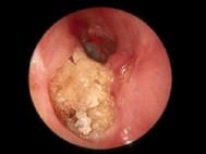 卫生招聘（耳鼻喉科汇总）,章节练习,基础复习,耳科学