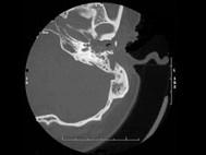 卫生招聘（耳鼻喉科汇总）,章节练习,基础复习,耳科学