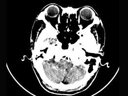 卫生招聘（耳鼻喉科汇总）,章节练习,基础复习,耳科学