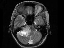 卫生招聘（耳鼻喉科汇总）,章节练习,基础复习,耳科学