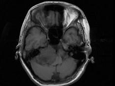 卫生招聘（耳鼻喉科汇总）,章节练习,基础复习,耳科学