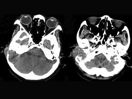 卫生招聘(耳鼻喉科汇总),章节练习,基础复习,耳科学 卫生招聘(耳鼻喉科汇总),章节练习,基础复习,耳科学