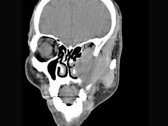 卫生招聘（耳鼻喉科汇总）,章节练习,基础复习,鼻科学