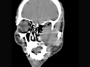 卫生招聘（耳鼻喉科汇总）,章节练习,基础复习,鼻科学