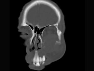 卫生招聘（耳鼻喉科汇总）,章节练习,基础复习,鼻科学