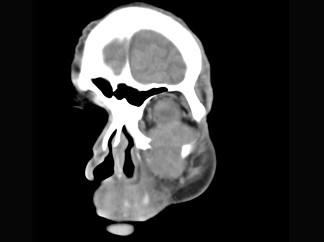 卫生招聘（耳鼻喉科汇总）,章节练习,基础复习,鼻科学