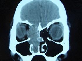卫生招聘（耳鼻喉科汇总）,章节练习,基础复习,鼻科学