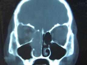 卫生招聘（耳鼻喉科汇总）,章节练习,基础复习,鼻科学