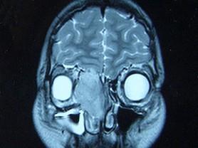 卫生招聘（耳鼻喉科汇总）,章节练习,基础复习,鼻科学