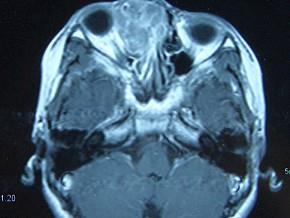 卫生招聘（耳鼻喉科汇总）,章节练习,基础复习,鼻科学