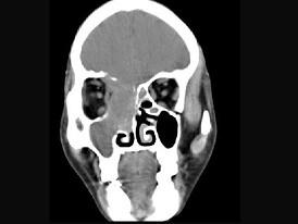 卫生招聘（耳鼻喉科汇总）,章节练习,基础复习,鼻科学