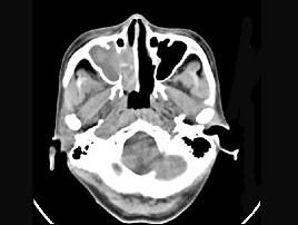 卫生招聘（耳鼻喉科汇总）,章节练习,基础复习,鼻科学