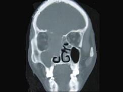 卫生招聘（耳鼻喉科汇总）,章节练习,基础复习,鼻科学
