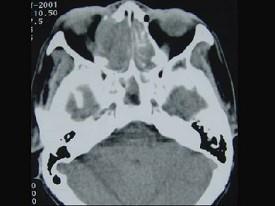 卫生招聘（耳鼻喉科汇总）,章节练习,基础复习,鼻科学