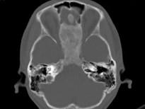 卫生招聘（耳鼻喉科汇总）,章节练习,基础复习,鼻科学