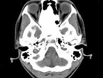 卫生招聘（耳鼻喉科汇总）,章节练习,基础复习,鼻科学