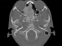 卫生招聘（耳鼻喉科汇总）,章节练习,基础复习,鼻科学