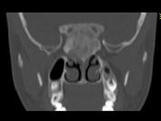卫生招聘（耳鼻喉科汇总）,章节练习,基础复习,鼻科学