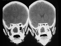 卫生招聘（耳鼻喉科汇总）,章节练习,基础复习,鼻科学