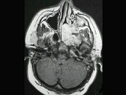 卫生招聘（耳鼻喉科汇总）,章节练习,基础复习,鼻科学