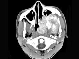 卫生招聘（耳鼻喉科汇总）,章节练习,基础复习,鼻科学