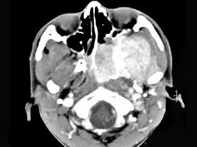 卫生招聘（耳鼻喉科汇总）,章节练习,基础复习,鼻科学