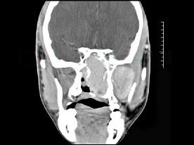 卫生招聘（耳鼻喉科汇总）,章节练习,基础复习,鼻科学