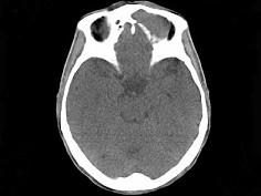 卫生招聘（耳鼻喉科汇总）,章节练习,基础复习,鼻科学