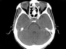 卫生招聘（耳鼻喉科汇总）,章节练习,基础复习,鼻科学