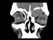 卫生招聘（耳鼻喉科汇总）,章节练习,基础复习,鼻科学