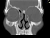 卫生招聘（耳鼻喉科汇总）,章节练习,基础复习,鼻科学