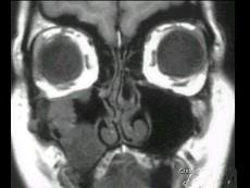 卫生招聘（耳鼻喉科汇总）,章节练习,基础复习,鼻科学