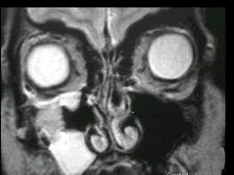 卫生招聘（耳鼻喉科汇总）,章节练习,基础复习,鼻科学