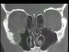 卫生招聘（耳鼻喉科汇总）,章节练习,基础复习,鼻科学