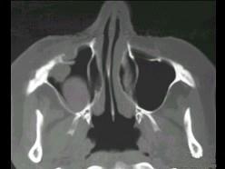 卫生招聘（耳鼻喉科汇总）,章节练习,基础复习,鼻科学