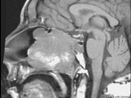 卫生招聘（耳鼻喉科汇总）,章节练习,基础复习,鼻科学