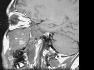 卫生招聘（耳鼻喉科汇总）,章节练习,基础复习,鼻科学