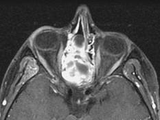 卫生招聘（耳鼻喉科汇总）,章节练习,基础复习,鼻科学