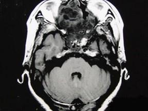 卫生招聘（耳鼻喉科汇总）,章节练习,基础复习,鼻科学