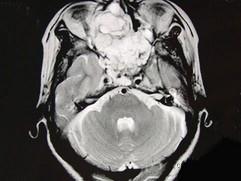 卫生招聘（耳鼻喉科汇总）,章节练习,基础复习,鼻科学
